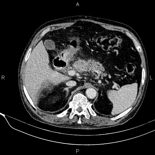 Acute pancreatitis (Radiopaedia 85146-100701 Axial C+ portal venous phase 22).jpg