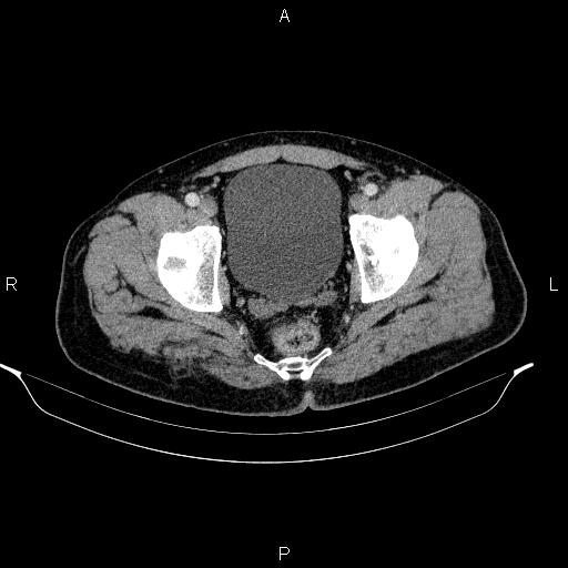 Acute pancreatitis (Radiopaedia 85390-101010 Axial C+ portal venous phase 100).jpg