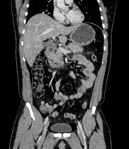 Acute pancreatitis (Radiopaedia 87428-103757 Coronal C+ portal venous phase 40).jpg