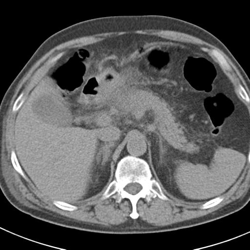File:Acute pancreatitis and walled-off necrosis (Radiopaedia 29888-30403 Axial non-contrast 18).jpg