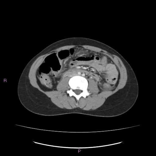 Acute pancreatitis secondary to stone at minor papilla and pancreatic divisum (Radiopaedia 76570-88333 Axial C+ portal venous phase 41).jpg