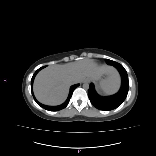 Acute pancreatitis secondary to stone at minor papilla and pancreatic divisum (Radiopaedia 76570-88333 Axial non-contrast 10).jpg