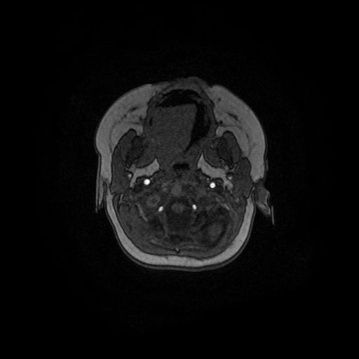 Acute phase of hemiconvulsion-hemiplegia epilepsy syndrome (Radiopaedia 29309-29745 Axial TOF angiography 157).jpg