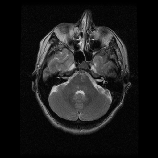 File:Acute pontine infarct from vertebral artery dissection (Radiopaedia 34111-35370 Axial T2 5).png