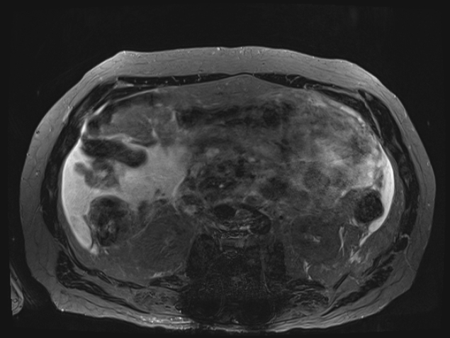 Acute portal vein thrombosis (Radiopaedia 73198-83925 Axial Heavily T2 thin cuts 57).jpg