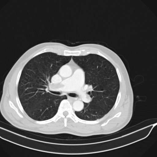 Acute pulmonary embolism (Radiopaedia 69510-79390 Axial lung window 2).jpg