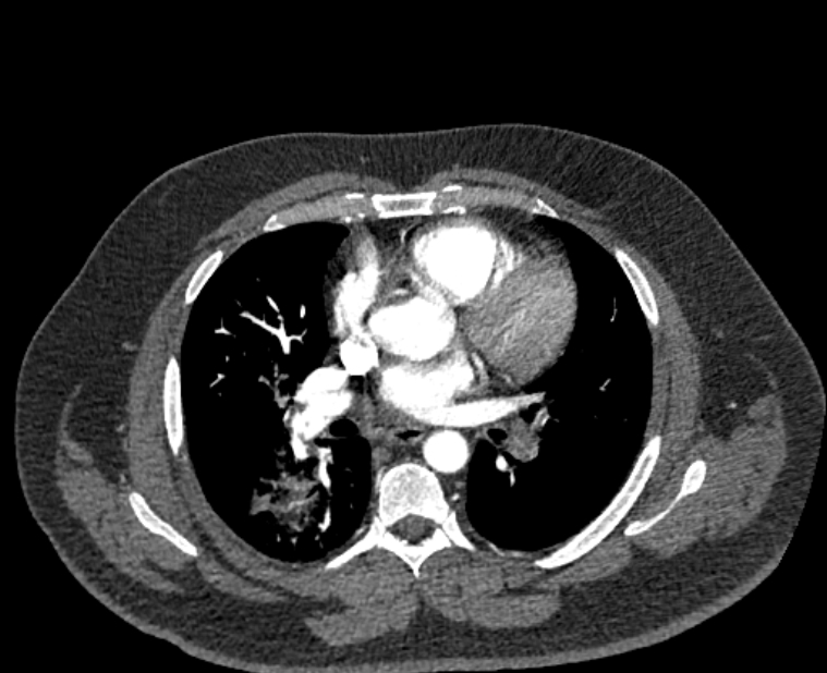 Acute pulmonary embolism with pulmonary infarcts (Radiopaedia 77688-89908 Axial C+ CTPA 32).jpg