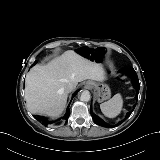 Acute renal infarction (Radiopaedia 59375-66736 Axial C+ portal venous phase 13).jpg