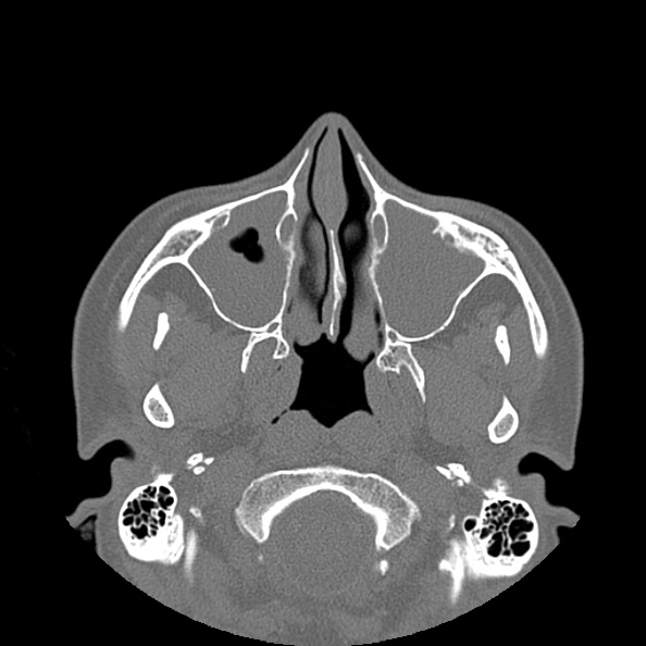 Acute sinusitis (Radiopaedia 23161-23215 Axial bone window 3).jpg