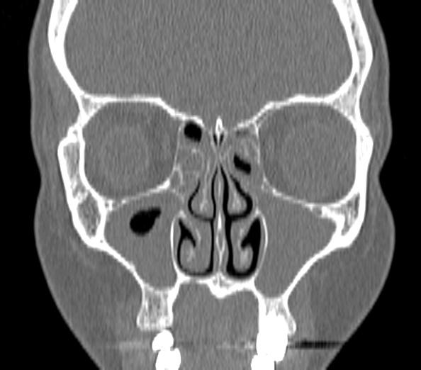 Acute sinusitis (Radiopaedia 40564-43158 Coronal bone window 15).jpg
