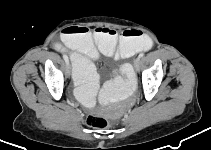 Acute small bowel (ileal) volvulus (Radiopaedia 71740-82139 Axial C+ portal venous phase 171).jpg