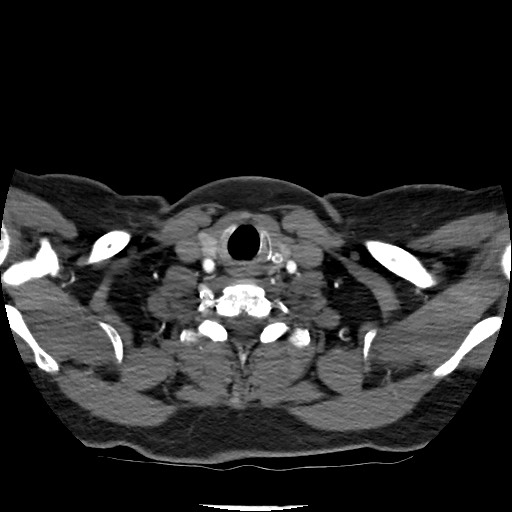 Acute subarachnoid hemorrhage and accessory anterior cerebral artery (Radiopaedia 69231-79009 Axial C+ arterial phase 35).jpg