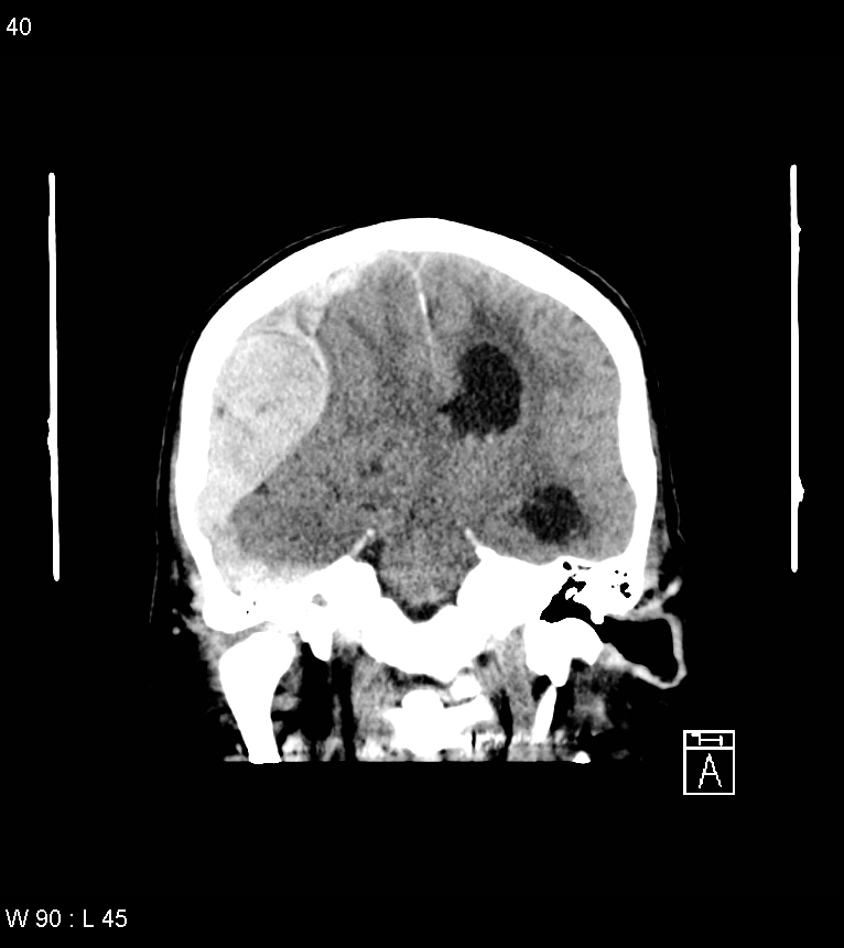 Acute subdural hematoma with myelofibrosis (Radiopaedia 52582-58494 Coronal non-contrast 31).jpg