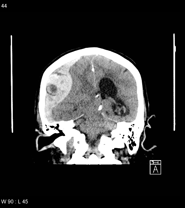 Acute subdural hematoma with myelofibrosis (Radiopaedia 52582-58494 Coronal non-contrast 35).jpg