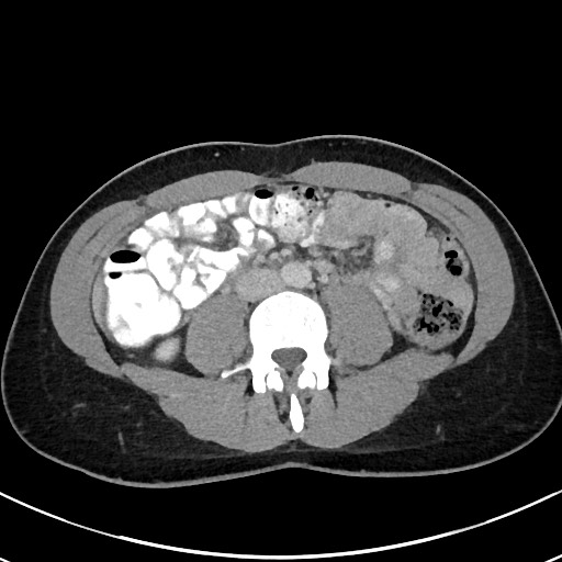 Acute uncomplicated appendicitis (Radiopaedia 61374-69304 Axial C+ portal venous phase 63).jpg