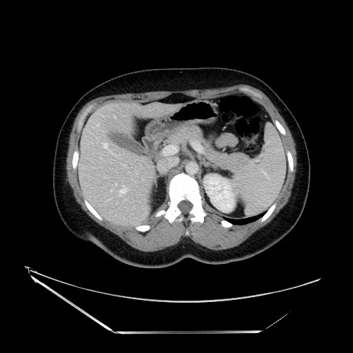 Acute uncomplicated appendicitis (Radiopaedia 73704-84499 Axial C+ portal venous phase 44).jpg