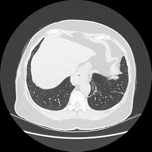 Adenocarcinoma in situ of lung (Radiopaedia 38685-40829 B 184).png