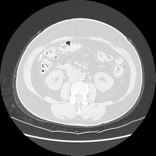 Adenocarcinoma in situ of lung (Radiopaedia 38685-40829 B 280).png
