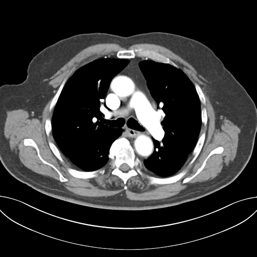 Adenocarcioma of rectum- T1 lesion (Radiopaedia 36921-38547 Axial C+ arterial phase 24).png