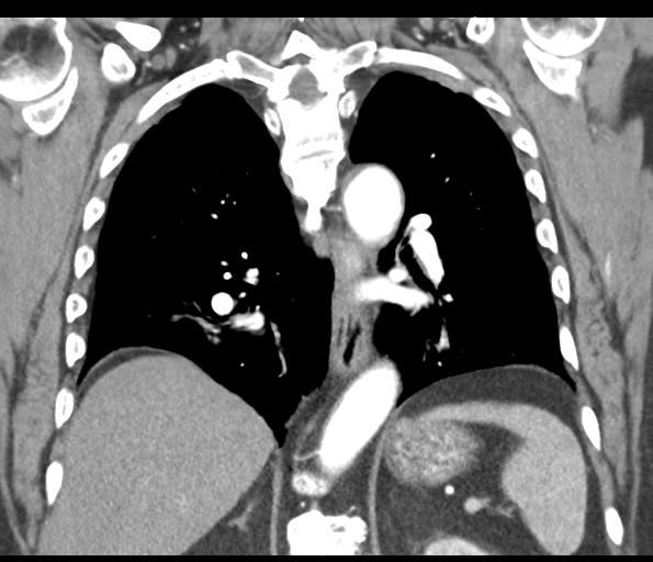 Adenocarcioma of rectum- T1 lesion (Radiopaedia 36921-38547 Coronal C+ arterial phase 41).png