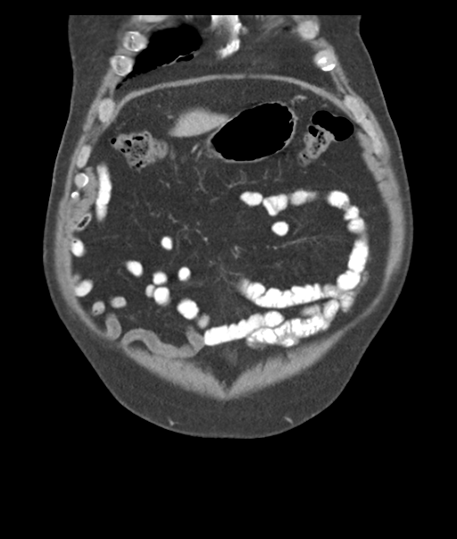 Adenocarcioma of rectum- T1 lesion (Radiopaedia 36921-38547 Coronal C+ portal venous phase 13).png