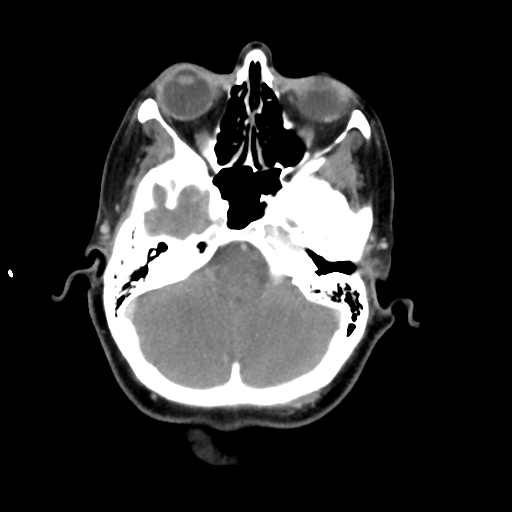 File:Adenoid cystic tumor of palate (Radiopaedia 46980-51518 Axial C+ delayed 15).png