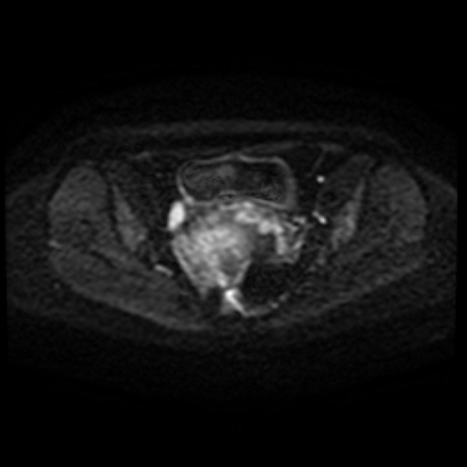Adenoma malignum of cervix (Radiopaedia 66441-75705 Axial DWI 62).jpg