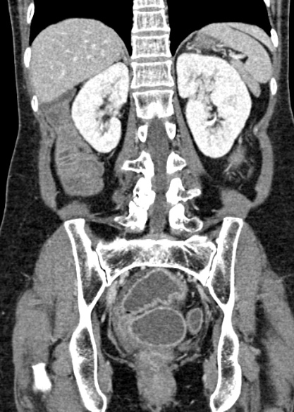 Adhesional small bowel obstruction (Radiopaedia 48397-53305 Coronal C+ portal venous phase 244).jpg