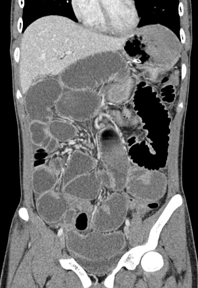 Adhesional small bowel obstruction (Radiopaedia 52107-57980 Coronal C+ portal venous phase 29).jpg