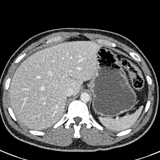 Adhesional small bowel obstruction (Radiopaedia 58900-66131 Axial C+ portal venous phase 10).jpg