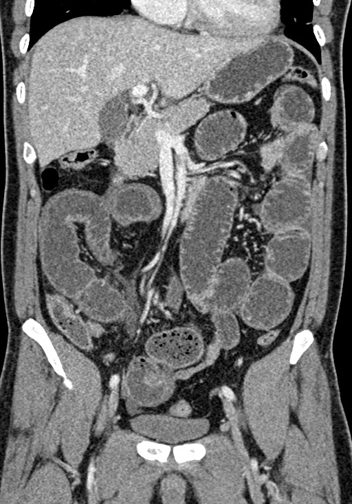 Adhesional small bowel obstruction (Radiopaedia 58900-66131 Coronal C+ portal venous phase 122).jpg