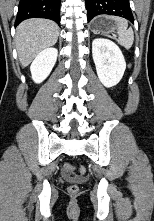 Adhesional small bowel obstruction (Radiopaedia 58900-66131 Coronal C+ portal venous phase 188).jpg