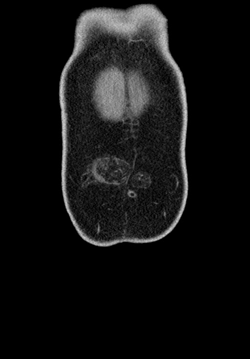 Adhesional small bowel obstruction (Radiopaedia 58900-66131 Coronal C+ portal venous phase 51).jpg
