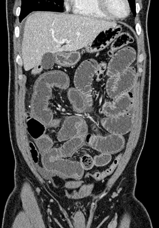 Adhesional small bowel obstruction (Radiopaedia 58900-66131 Coronal C+ portal venous phase 99).jpg