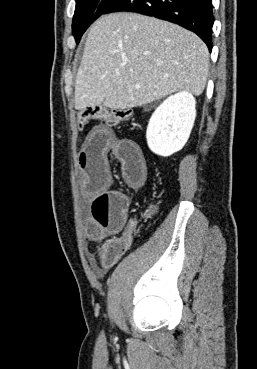 Adhesional small bowel obstruction (Radiopaedia 58900-66131 Sagittal C+ portal venous phase 63).jpg