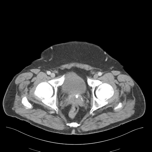 File:Adhesions within abdominal wall hernia (Radiopaedia 58283-65394 Axial C+ portal venous phase 80).png