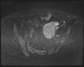 Adnexal multilocular cyst (O-RADS US 3- O-RADS MRI 3) (Radiopaedia 87426-103754 Axial DWI 70).jpg