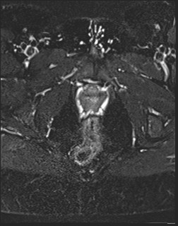 File:Adnexal multilocular cyst (O-RADS US 3- O-RADS MRI 3) (Radiopaedia 87426-103754 Axial T2 fat sat 23).jpg
