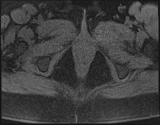 File:Adnexal multilocular cyst (O-RADS US 3. O-RADS MRI 3) (Radiopaedia 87426-103754 Axial 222).jpeg