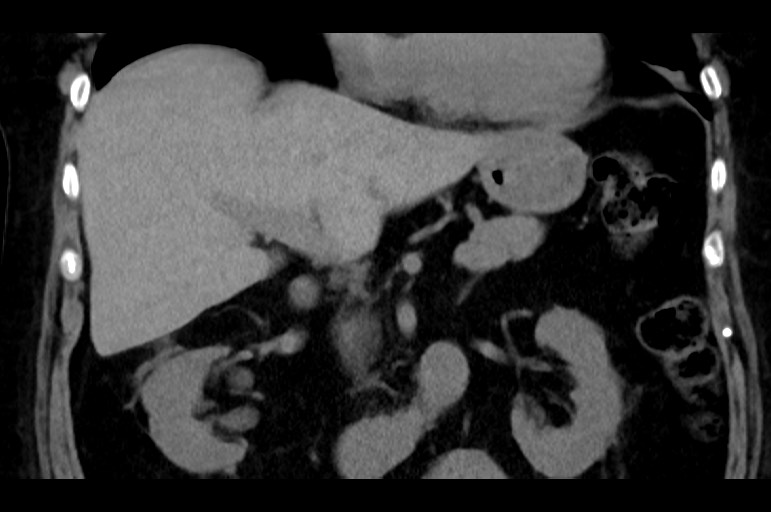 Adrenal cortical carcinoma (Radiopaedia 64017-72769 Coronal non-contrast 26).jpg