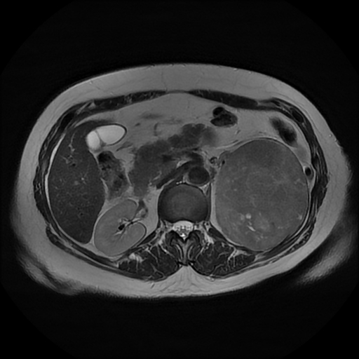 File:Adrenal cortical carcinoma (Radiopaedia 70906-81116 Axial T2 17).jpg