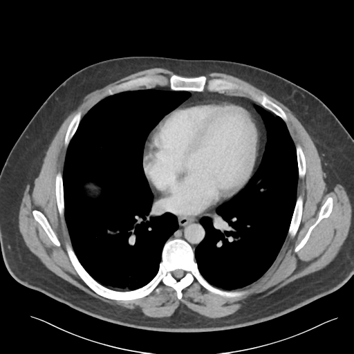 Adrenal cyst (Radiopaedia 45625-49777 Axial C+ portal venous phase 6).png