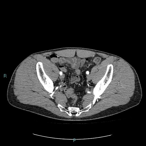 File:Adrenal cystic lymphangioma (Radiopaedia 83161-97534 Axial C+ arterial phase 82).jpg
