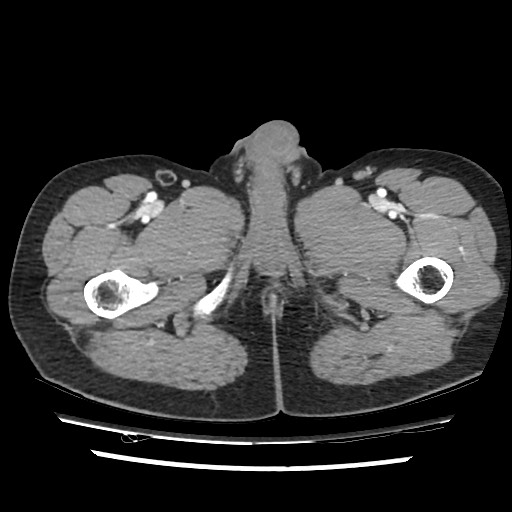 Adrenal gland trauma (Radiopaedia 81351-95078 Axial Dual bolus trauma C+ 130).jpg