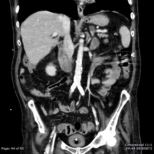 Adrenal metastasis (Radiopaedia 78425-91079 Sagittal C+ portal venous phase 31).jpg