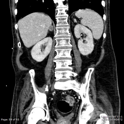 Adrenal metastasis (Radiopaedia 78425-91079 Sagittal C+ portal venous phase 46).jpg