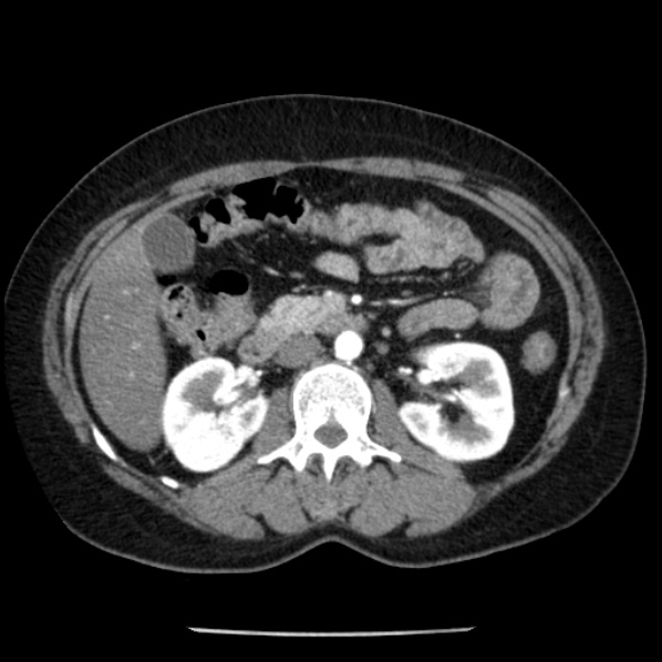 Adrenal myelolipoma (Radiopaedia 43401-46759 Axial C+ arterial phase 44).jpg