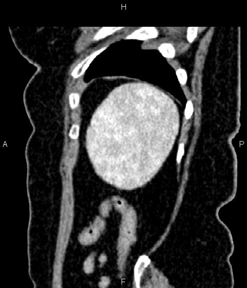 File:Adrenal myelolipoma (Radiopaedia 82742-96986 Sagittal renal cortical phase 93).jpg