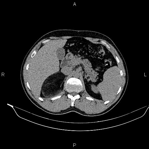 File:Adrenal myelolipoma (Radiopaedia 87794-104246 Axial non-contrast 34).jpg