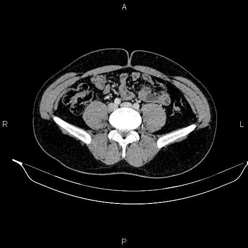 Adrenal myelolipoma (Radiopaedia 87794-104246 Axial renal cortical phase 69).jpg